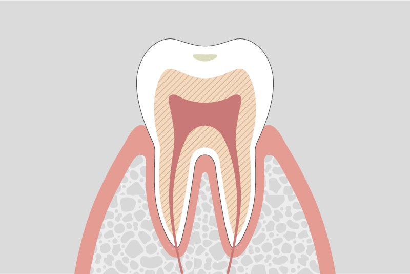 むし歯の進行段階とその治療方法