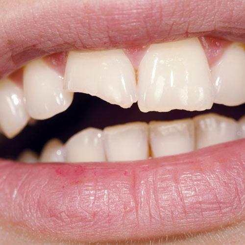 broken tooth