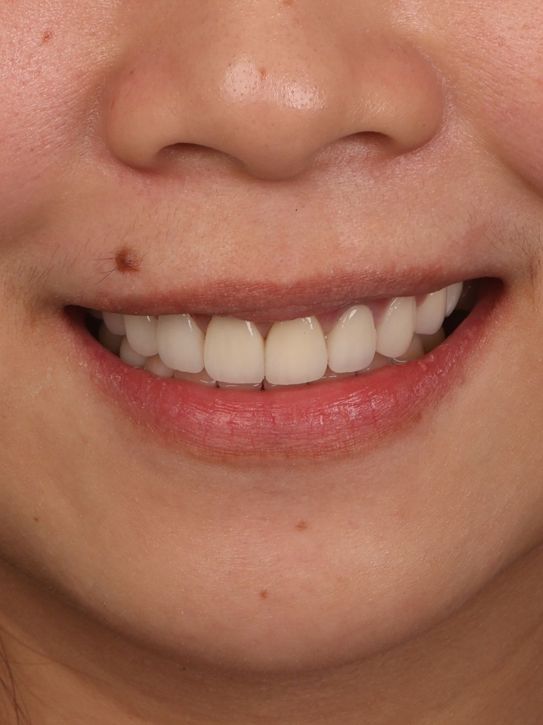 After photo showing bright natural smile following EMax crown and veneer restoration at Ora Dental Makati