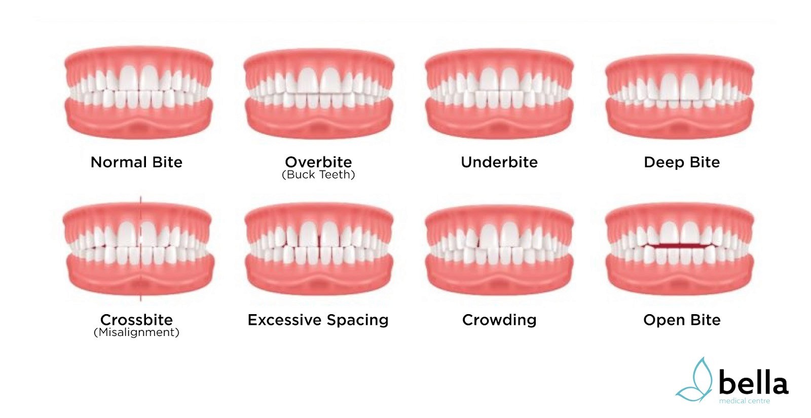 A picture showing common types of malocclusion.
