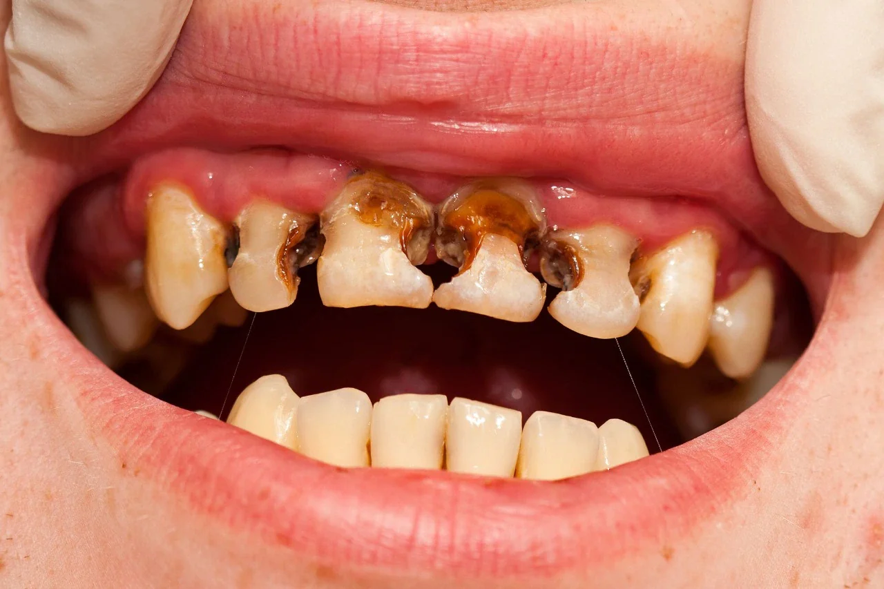 dental cavities
