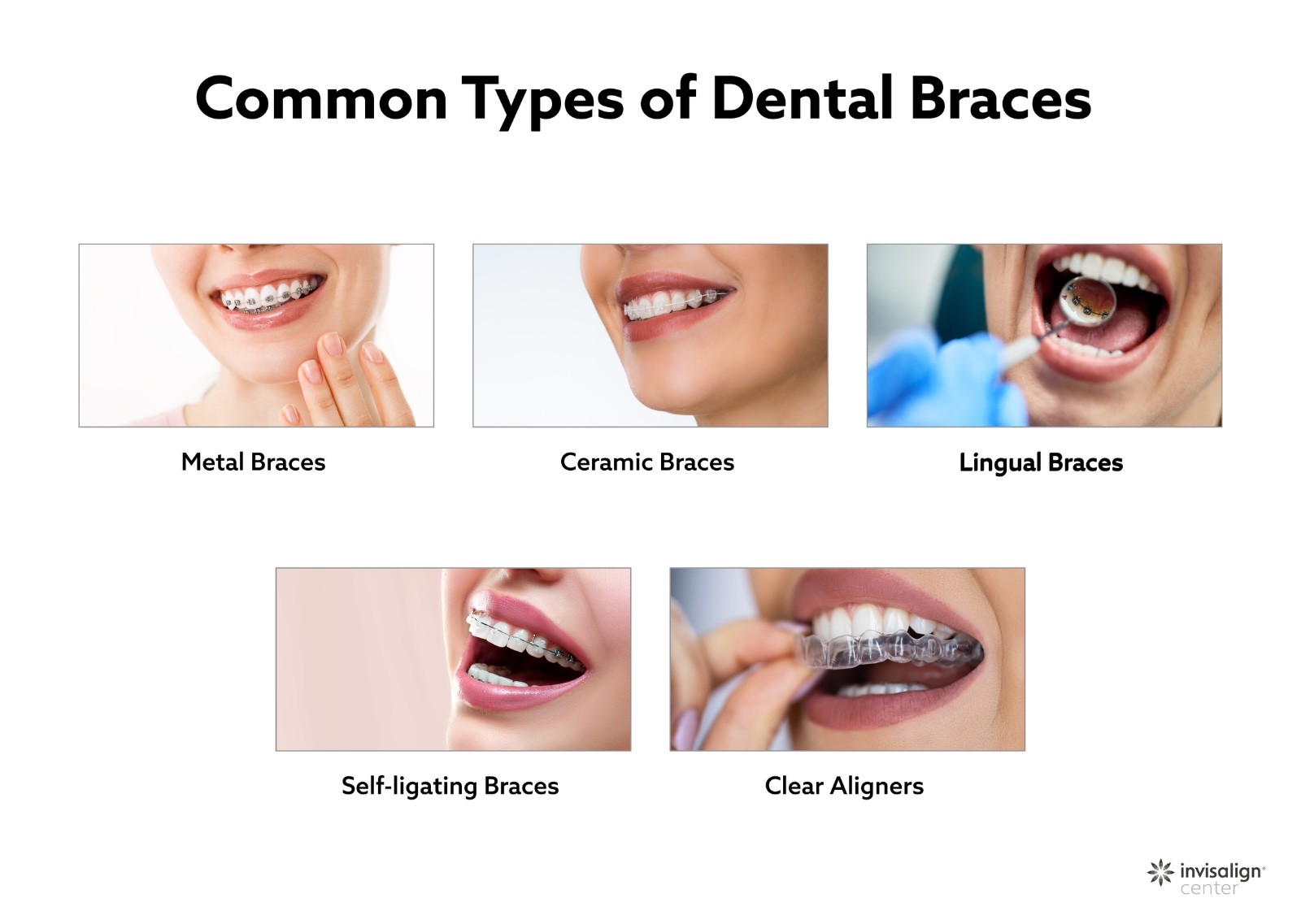 common types of dental braces