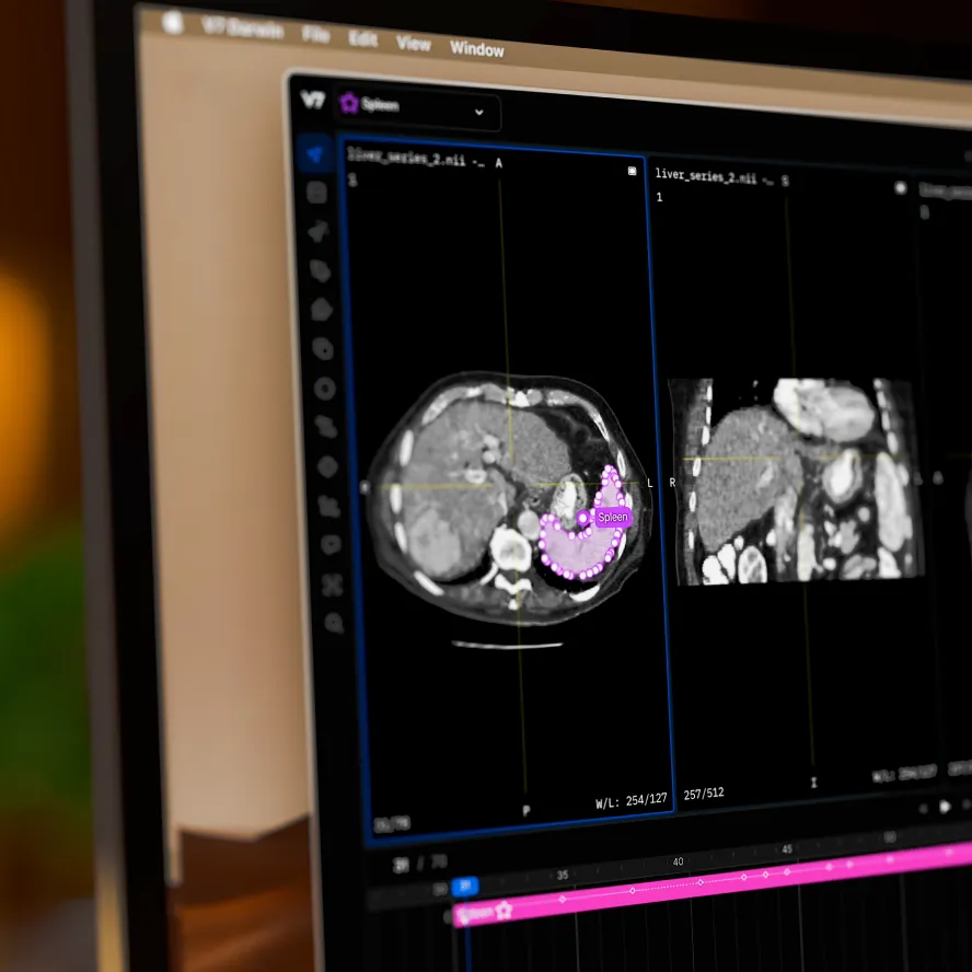 A DICOM annotation tool, data labeling where a spleen is being annotated