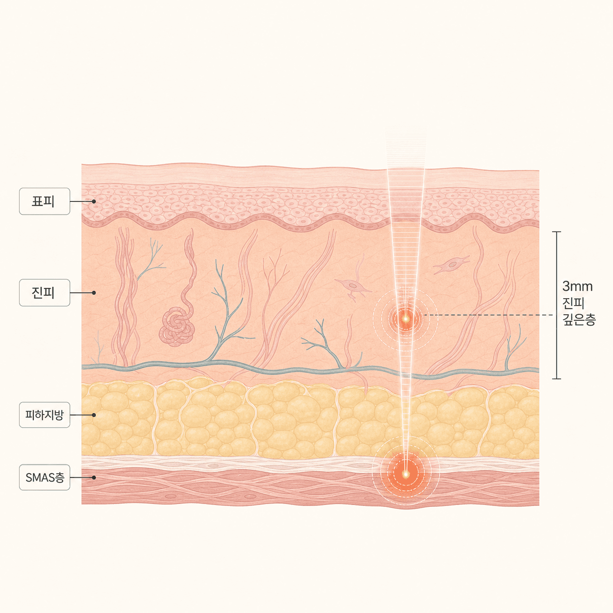 피부층별 열 전달 깊이 (표피·진피·SMAS층)