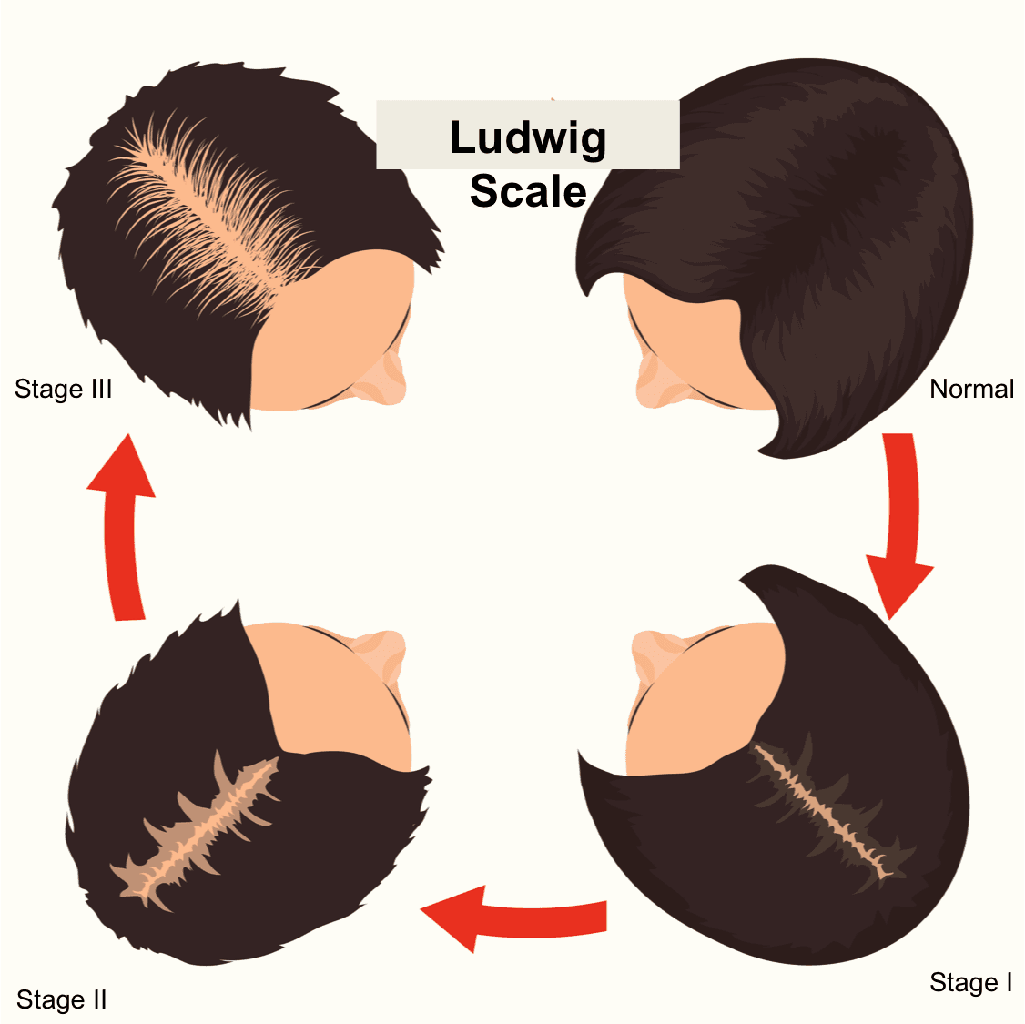 Shows the Ludwig scale of female pattern baldness which is followed by all partner doctors of hairhealth.ai