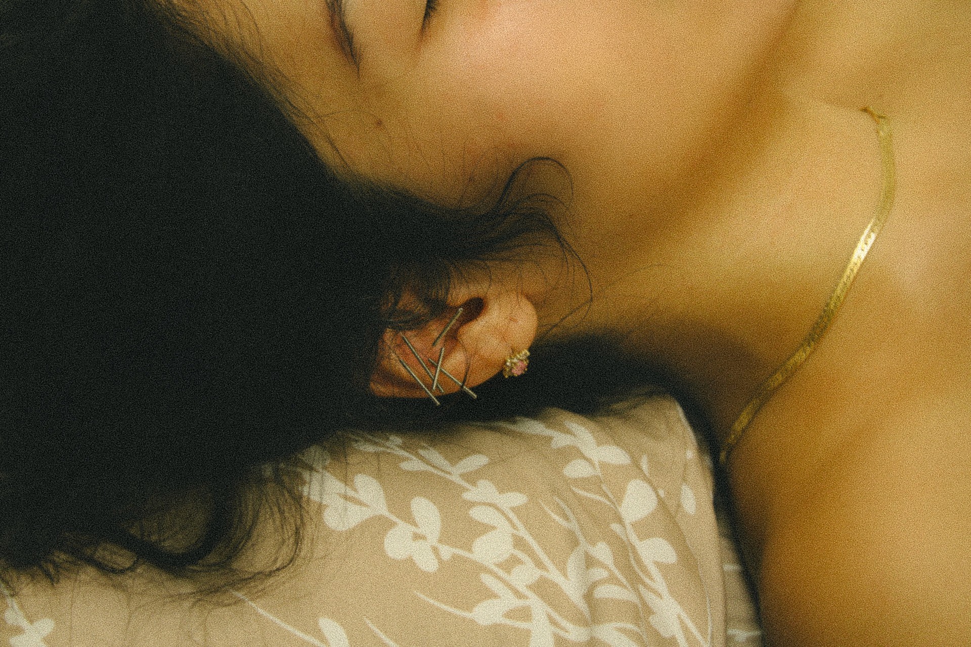 A woman with acupuncture needles placed in her ear for facial acupuncture