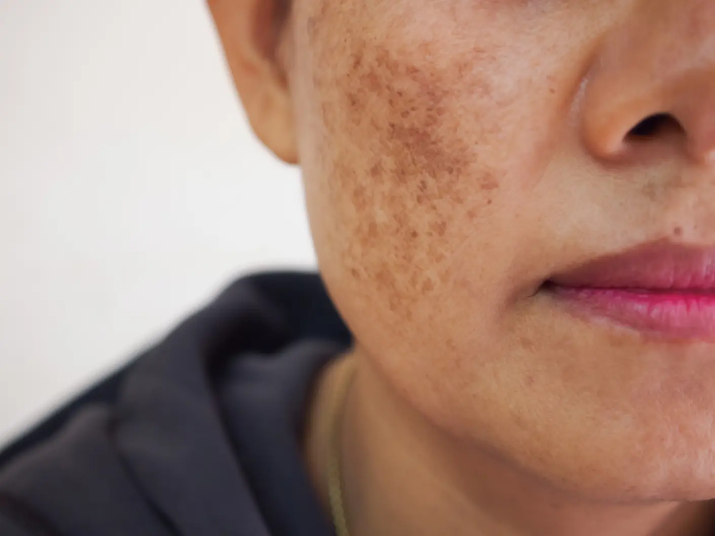 dark spots and hyperpigmentation