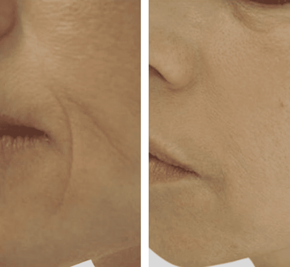 Laser treatment on woman's cheek with protective eye shield
