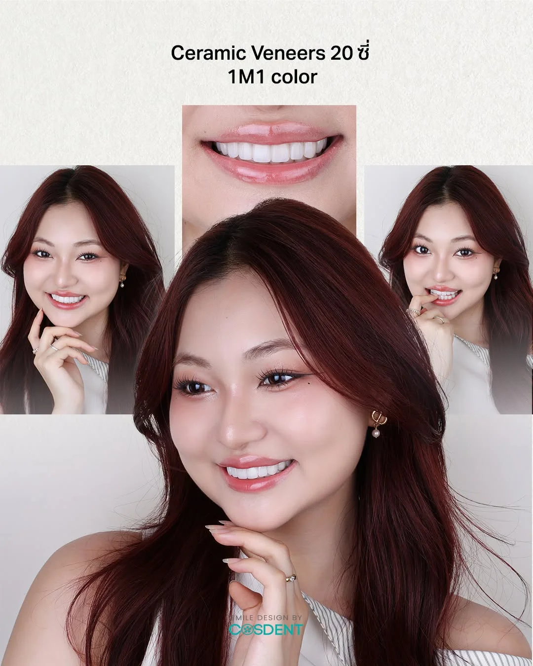 COSDENT smile collage, woman in a white top; label: 20 ceramic veneers, 1M1.