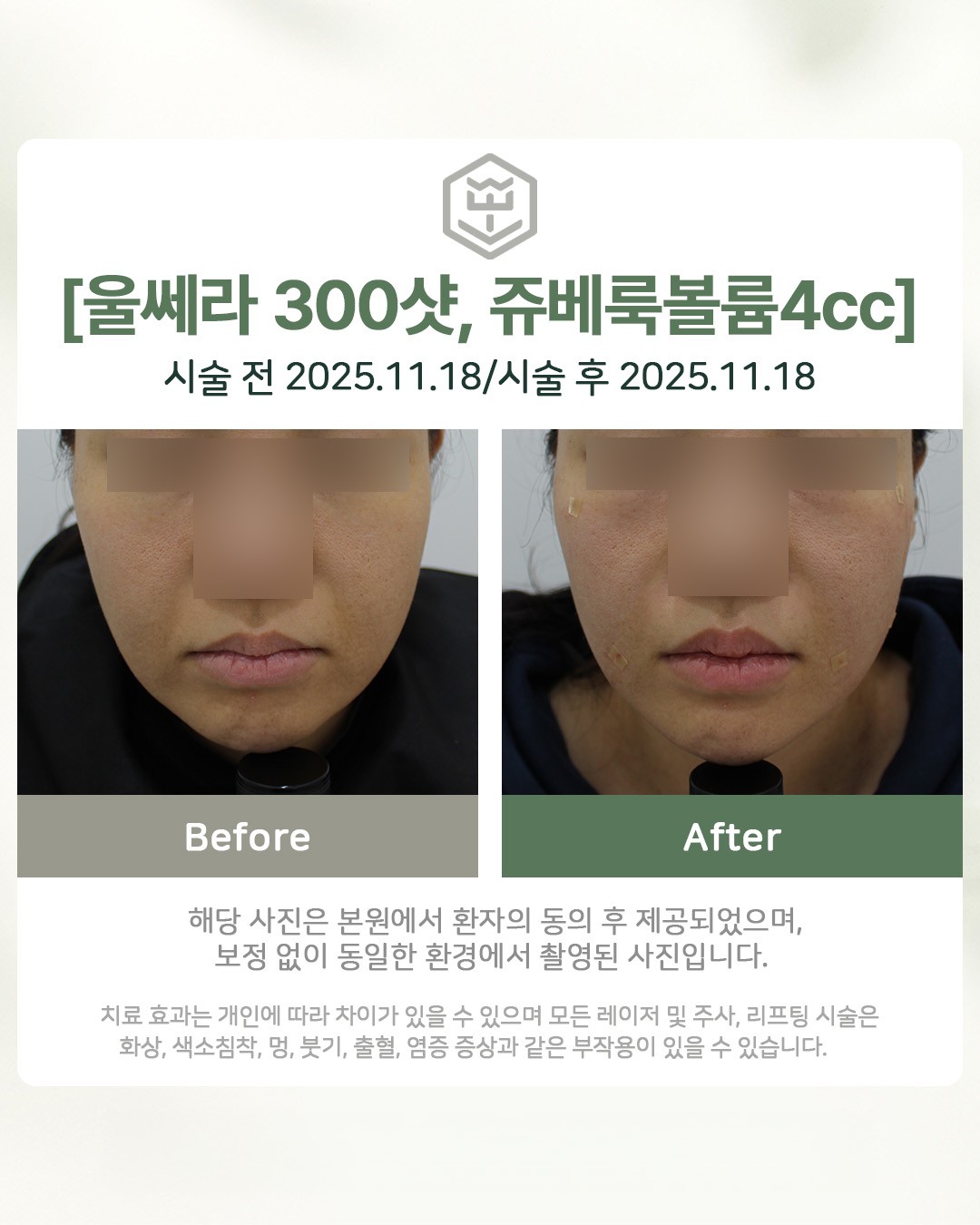 울쎄라 300샷 + 쥬베룩볼륨 4cc