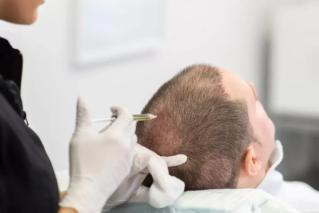 Close-up of a PRP hair restoration procedure, showing plasma being injected into the scalp to stimulate hair regrowth and strengthen follicles.
