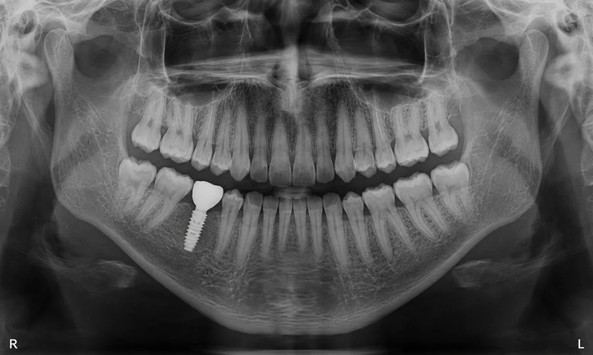 Patient smile after single tooth implant treatment showing a restored, natural-looking tooth replacement and improved smile appearance.