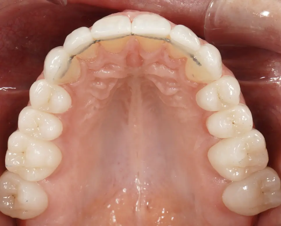 After prosthetic rehabilitation