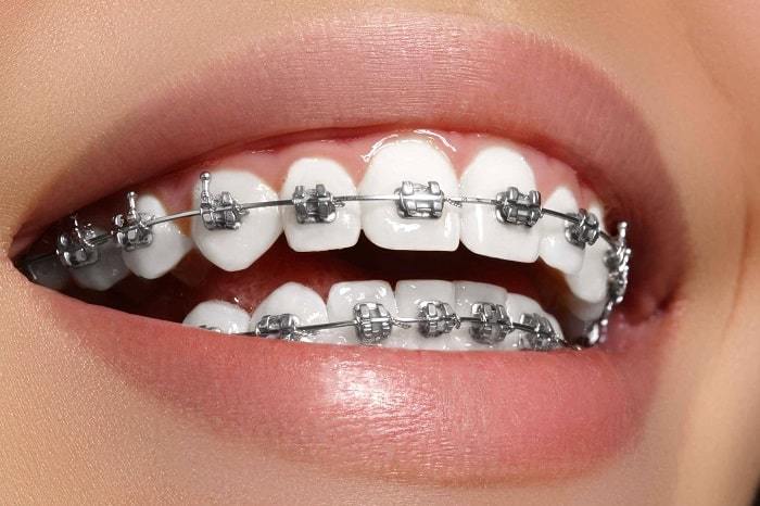 metal braces orthodontics dental