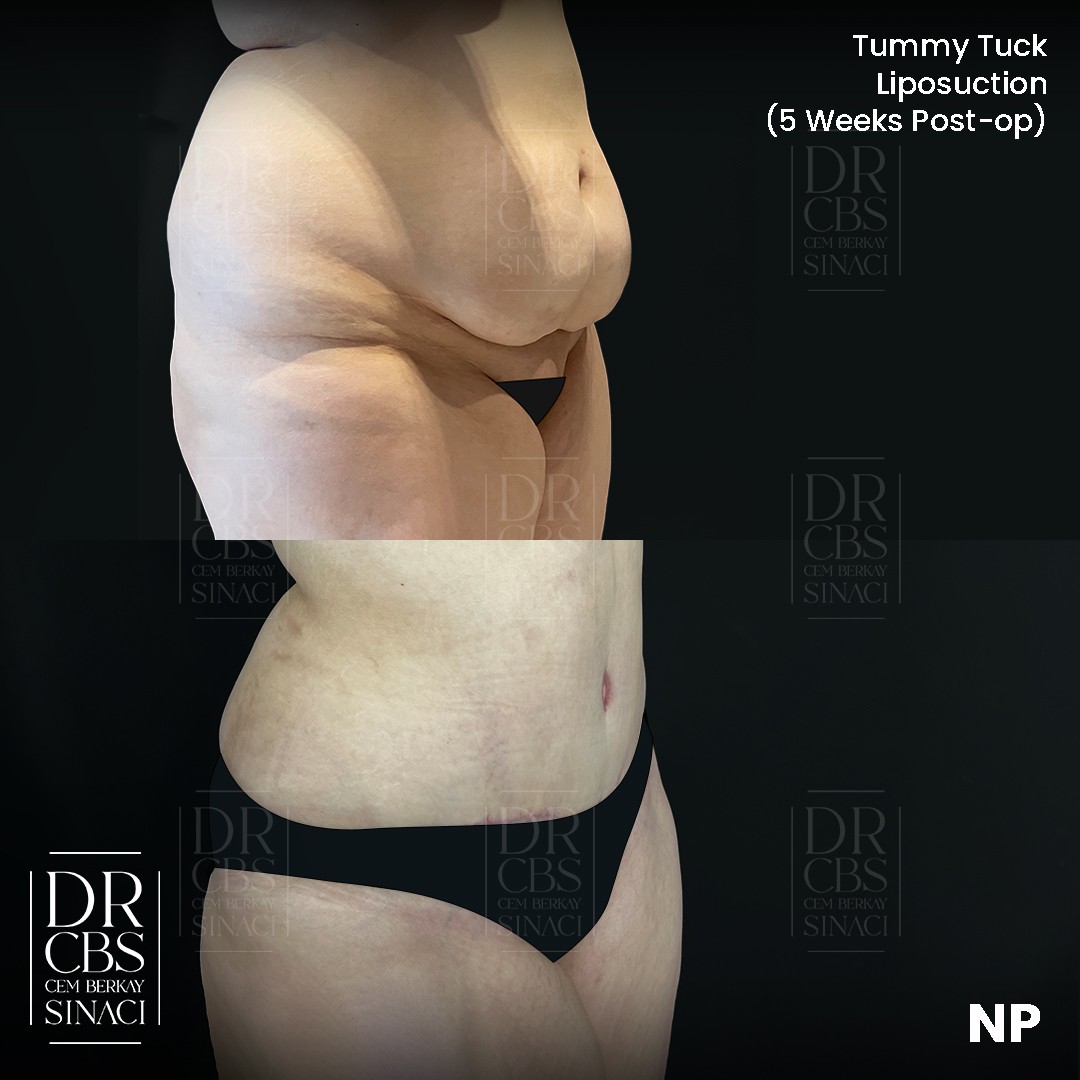 5 weeks before after photo of liposuction tummy tuck oblique view