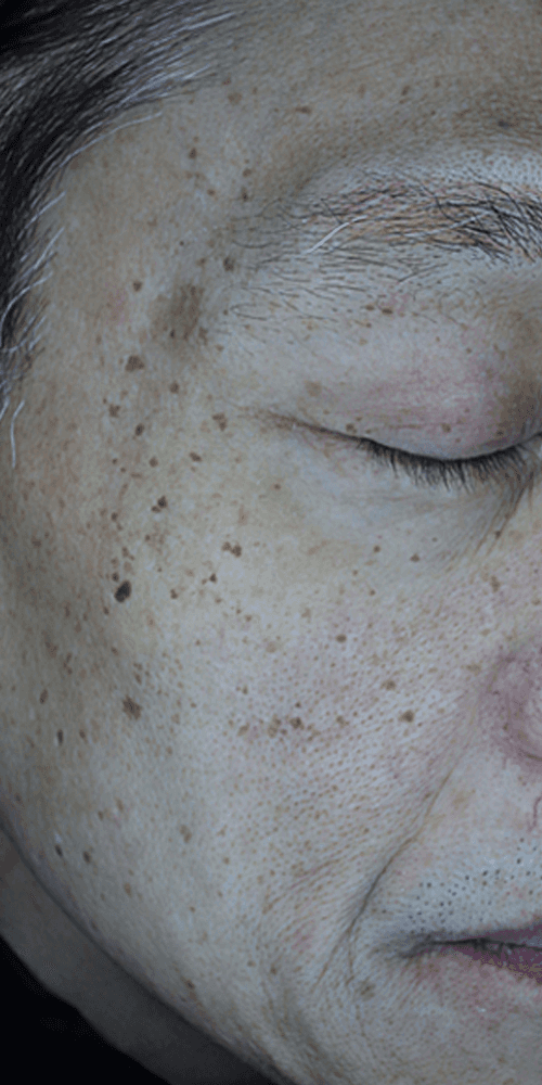 Pigmentation - Before