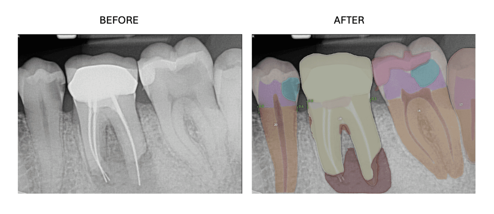 Before and after AI segmentation comparison on periapical radiographs