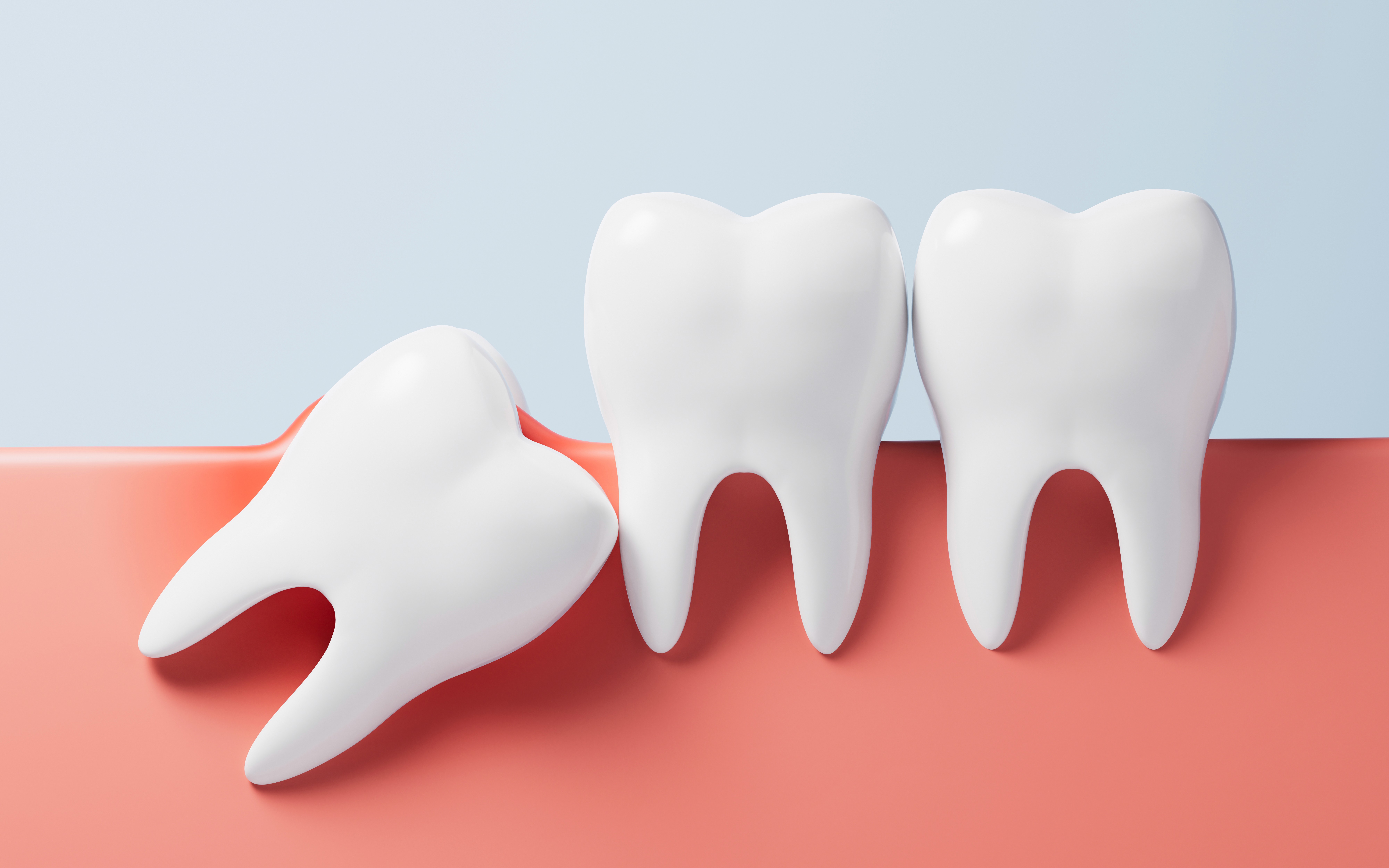 Illustration of a partially erupted and angled wisdom tooth pressing against adjacent teeth, highlighting the necessity for wisdom tooth removal.