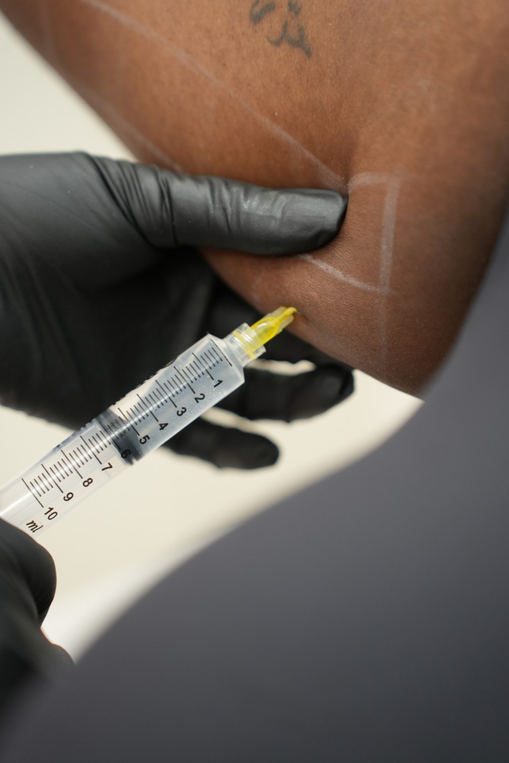 Client undergoing a non-surgical body contouring treatment in clinic