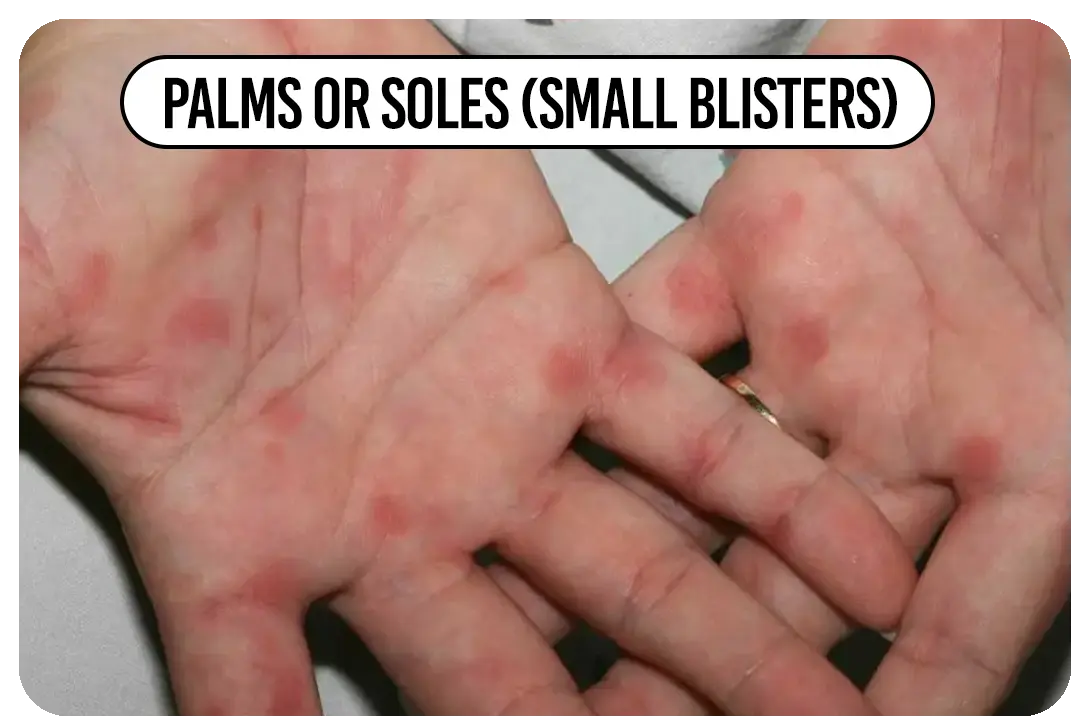 Palms or soles (small blisters)