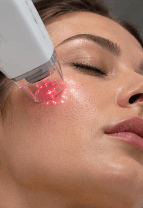RF Fractional treatment