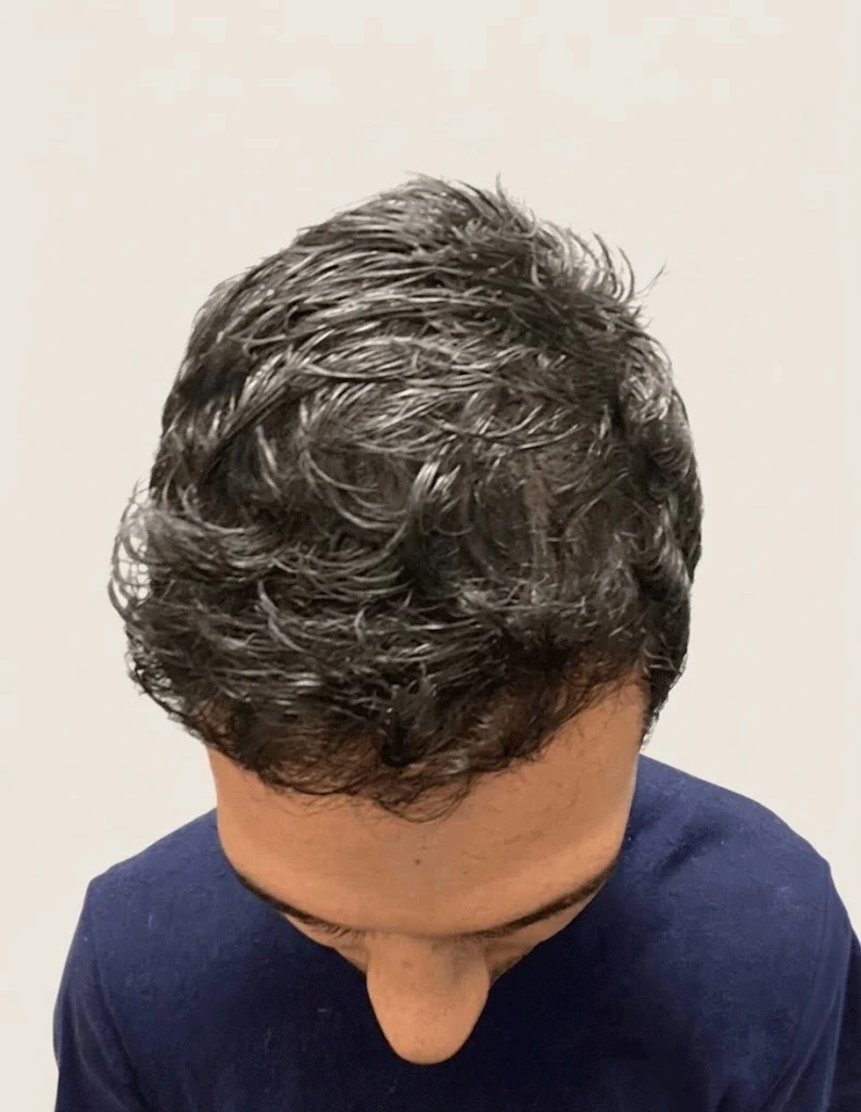Dichtes Haarwachstum nach der DHI-Methode beim Facharzt in Istanbul