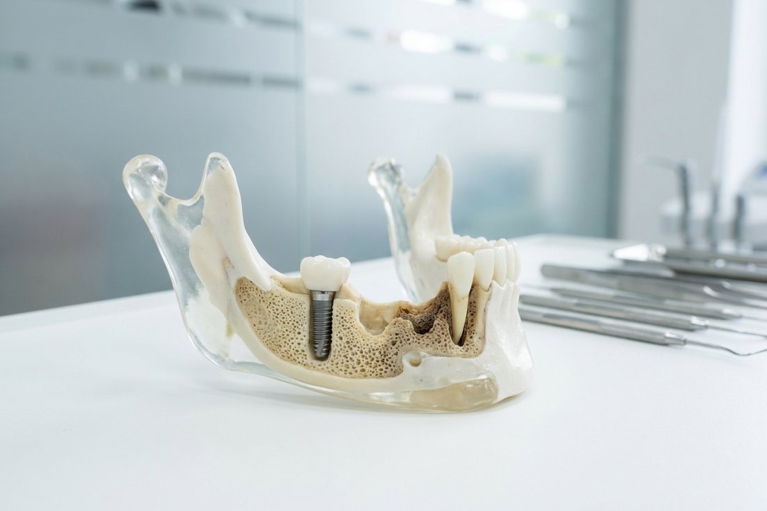 Jaw model showing a dental implant preserving bone next to an area of bone loss