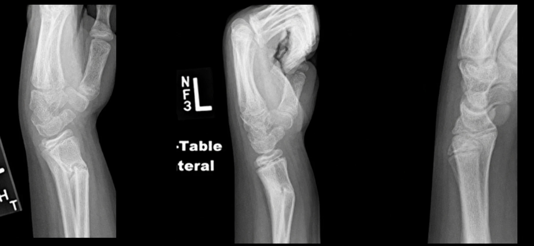 Sequence of X-rays of the same child’s forearm fracture showing healing and gradual remodelling over time.