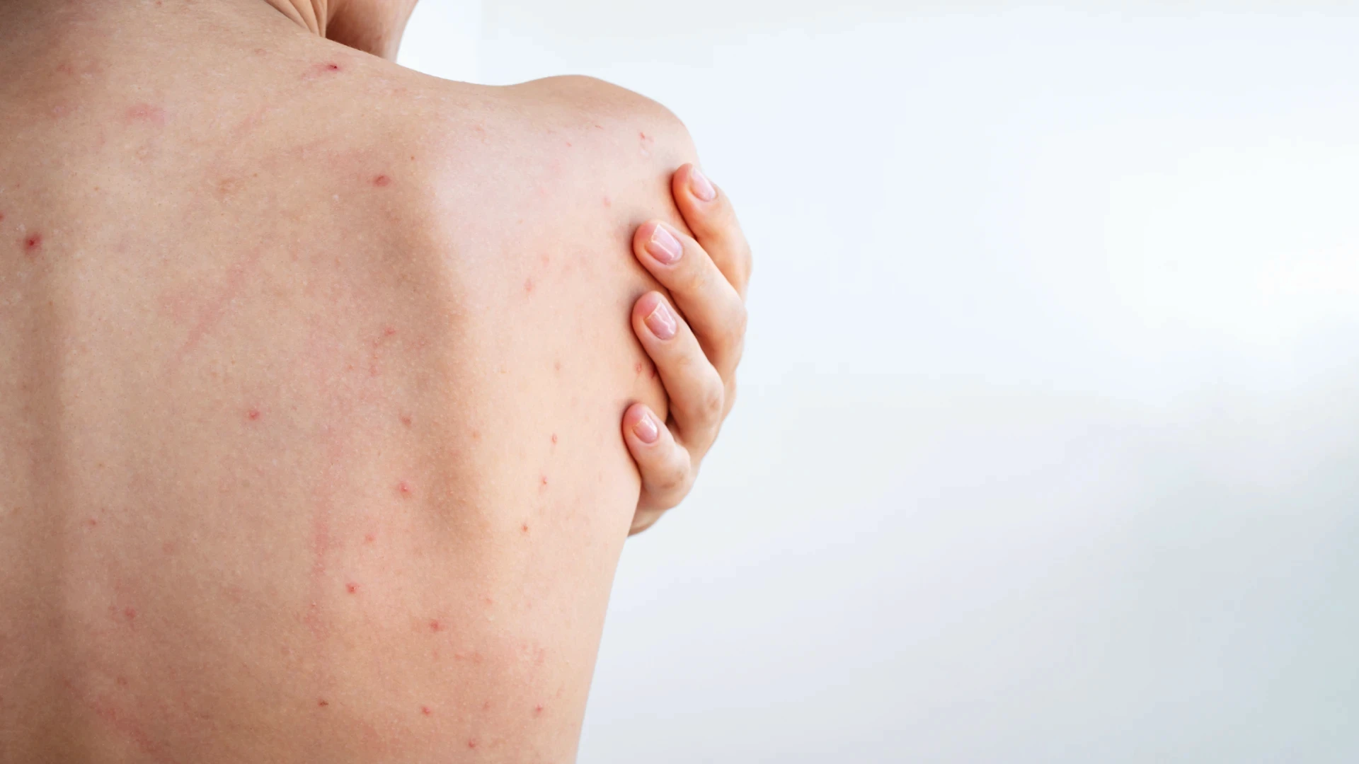 Causes of Back Acne