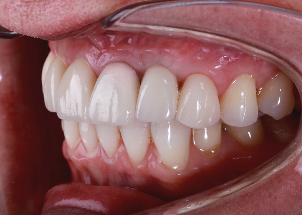 Kermické korunky na horných predných zuboch a na implantáte 