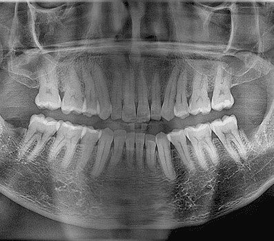 3rd molar extraction
