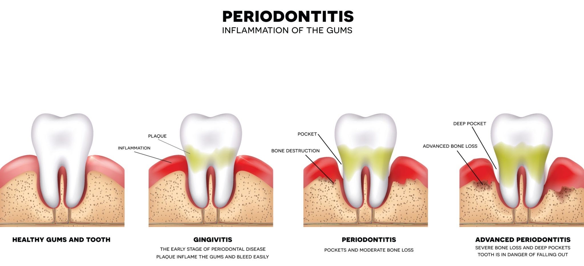 periodontitis