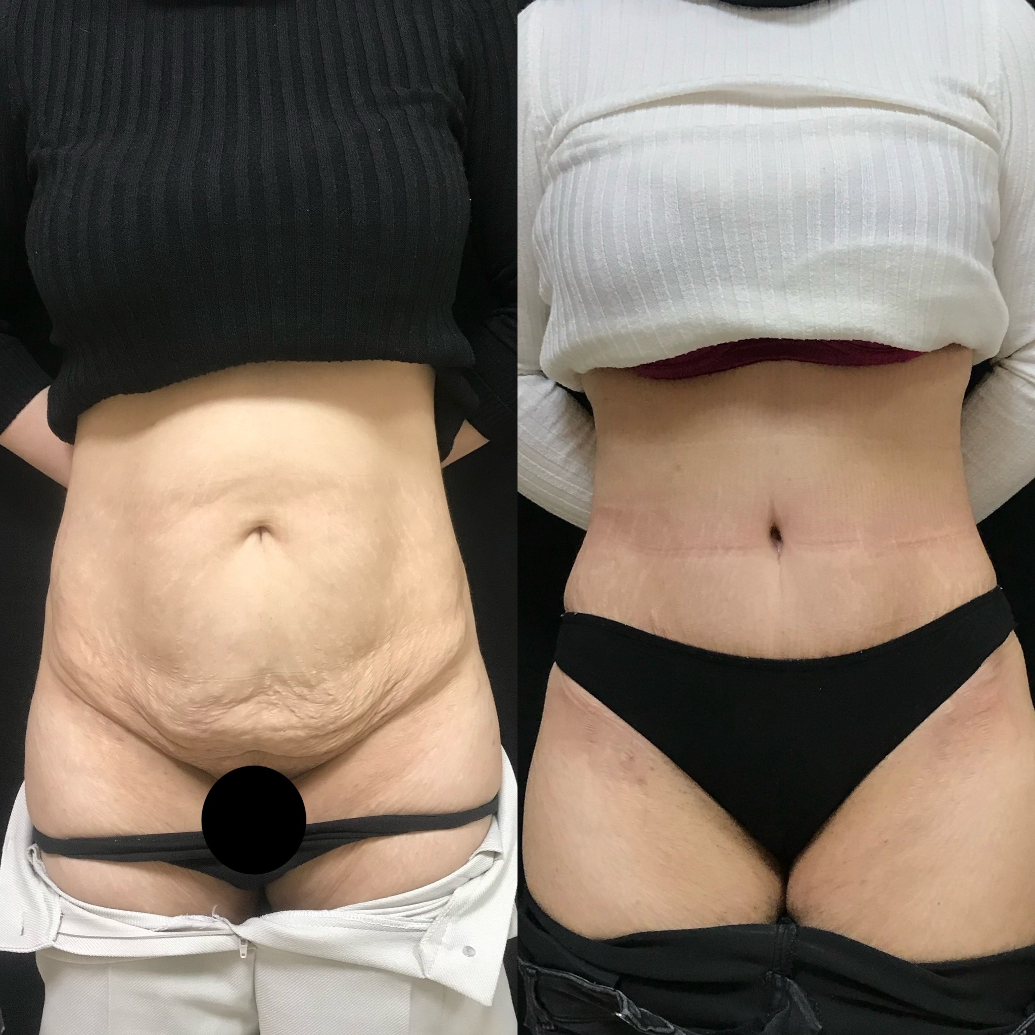 tummy tuck and liposuction before after result Istanbul, Turkey front view