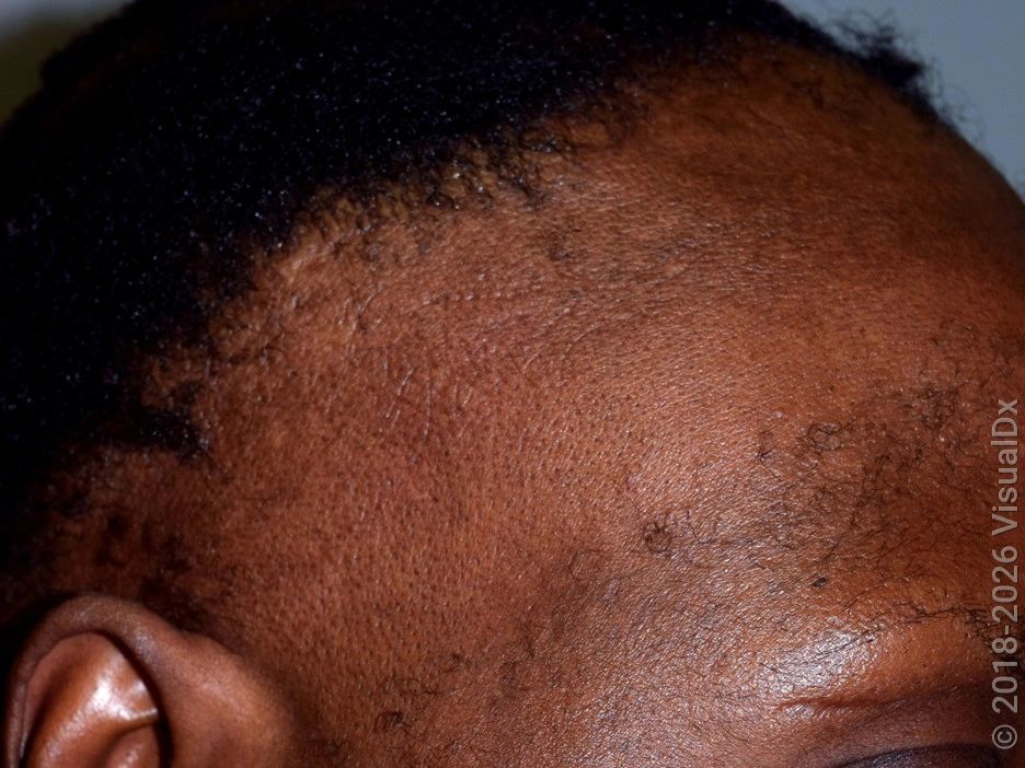 Frontal Fibrosing Alopecia — image from NorCal Hair Doctor™'s existing website
