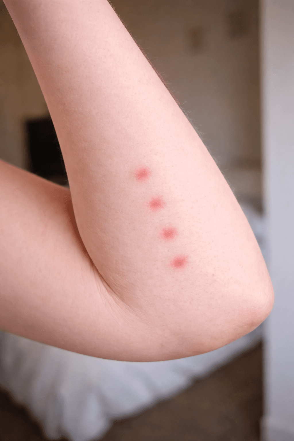 Rangée de piqûres de punaises de lit alignées sur un bras