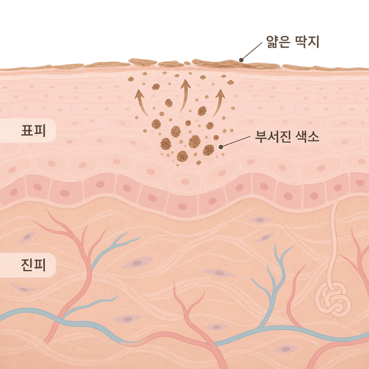 부서진 색소가 피부 위로 올라와 얇은 딱지로 앉는 모습