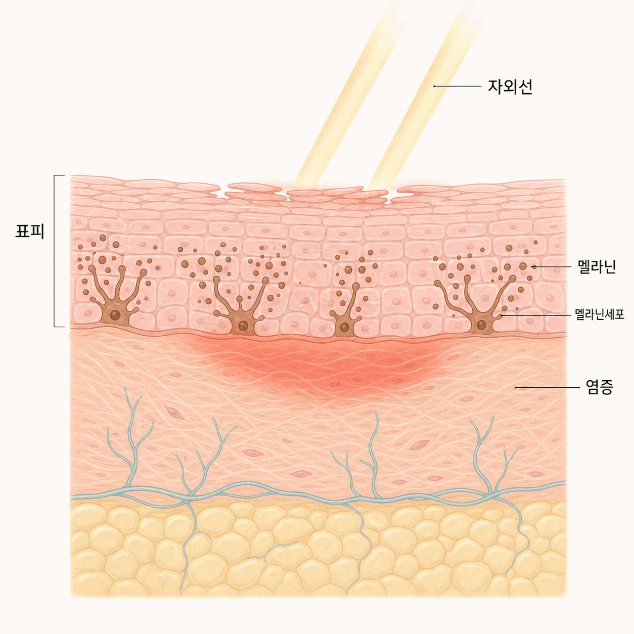 시술 후 남은 염증에 자외선이 겹치면 멜라닌이 더 늘어요