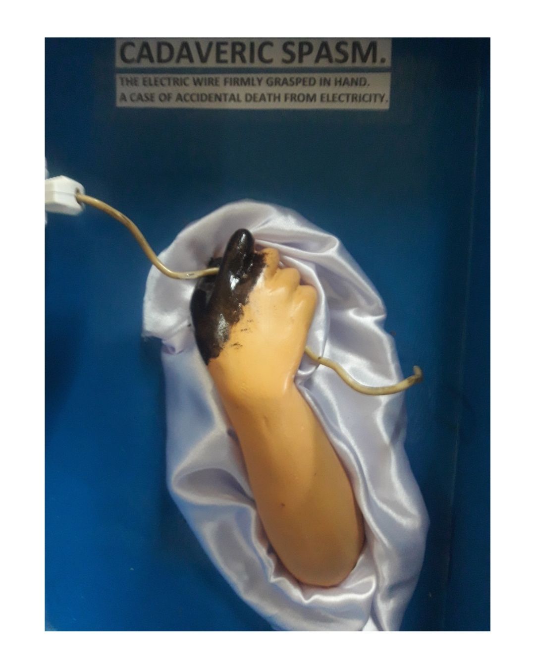 Cadaveric Spasm (Electrocution Case)