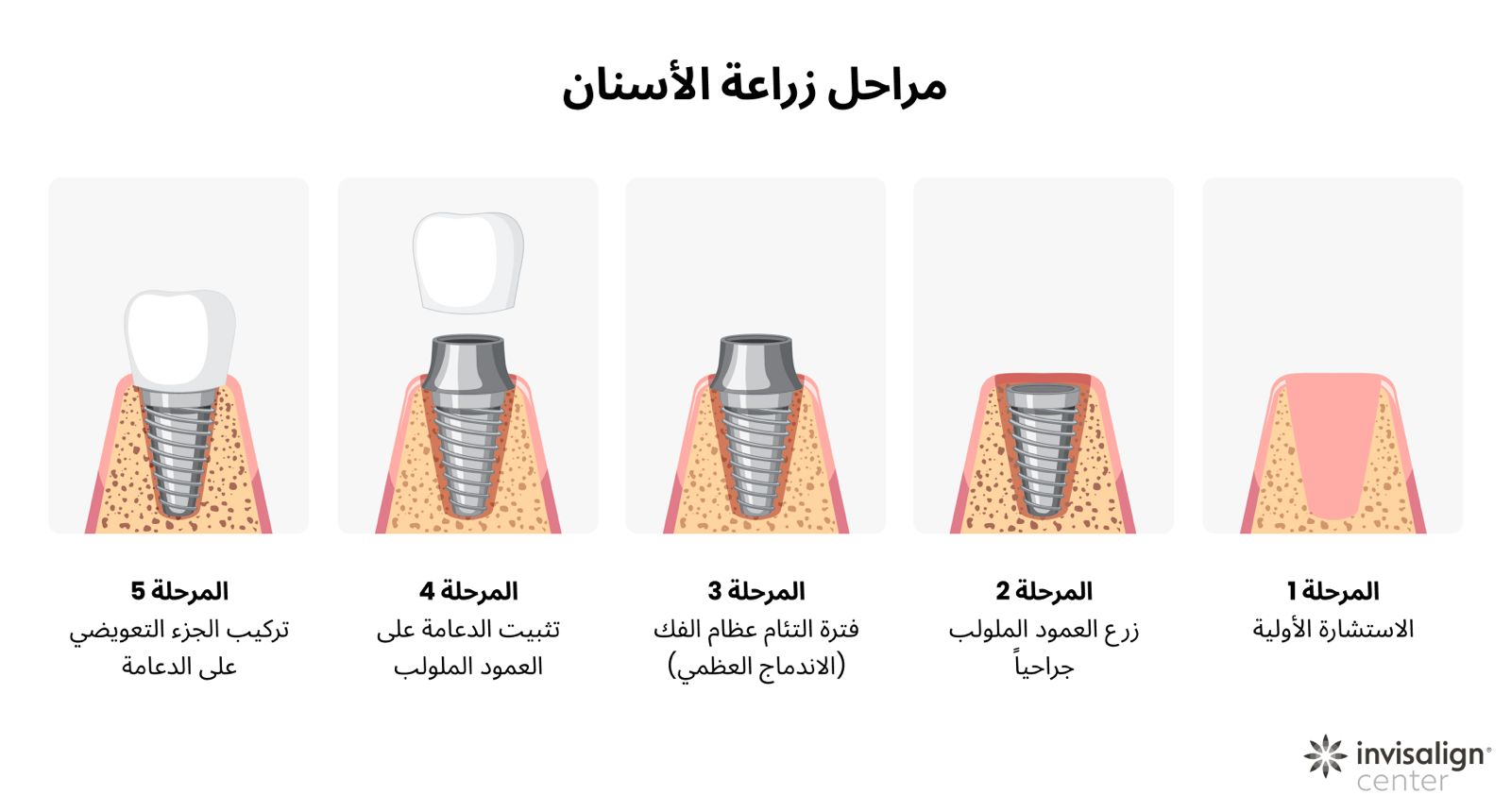 صورة توضيحية لعملية تصنيع الأسنان المزروعة وطريقة تركيبها.