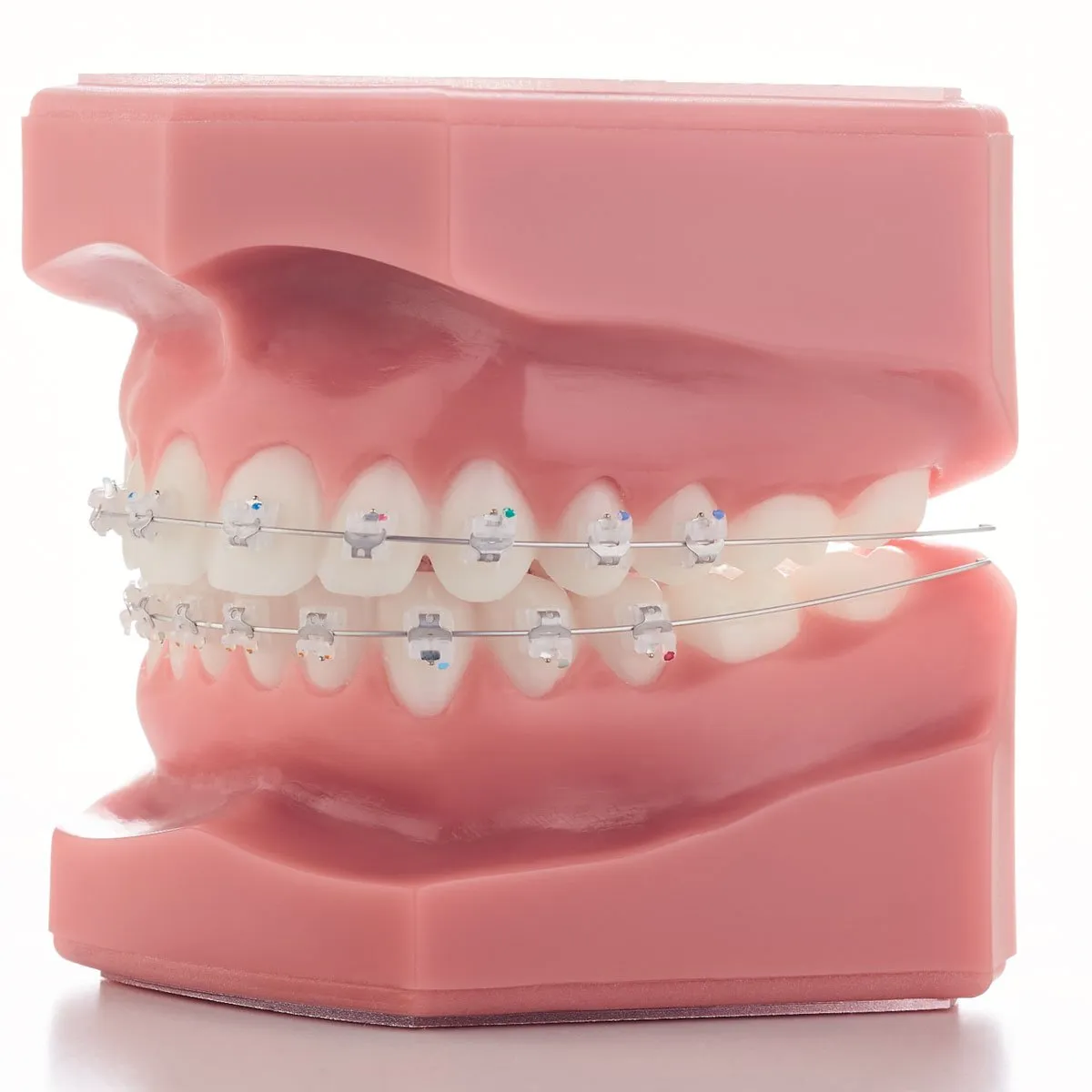 Clear Braces at Midtown Orthodontics in Midtown Toronto, Ontario