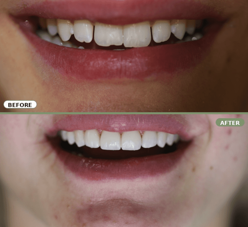 Before-and-after smile transformations from a top Canadian dentist