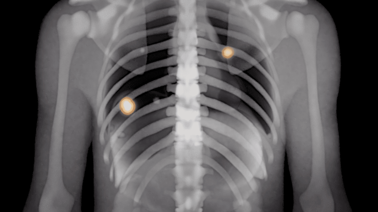 Human cell with abnormal molecular condensates that cause disease