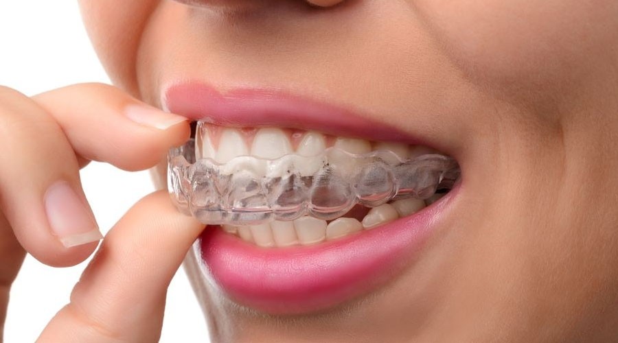 Sorriso com implante dentário ilustrado na gengiva, mostrando dentes brancos e saudáveis após reabilitação oral