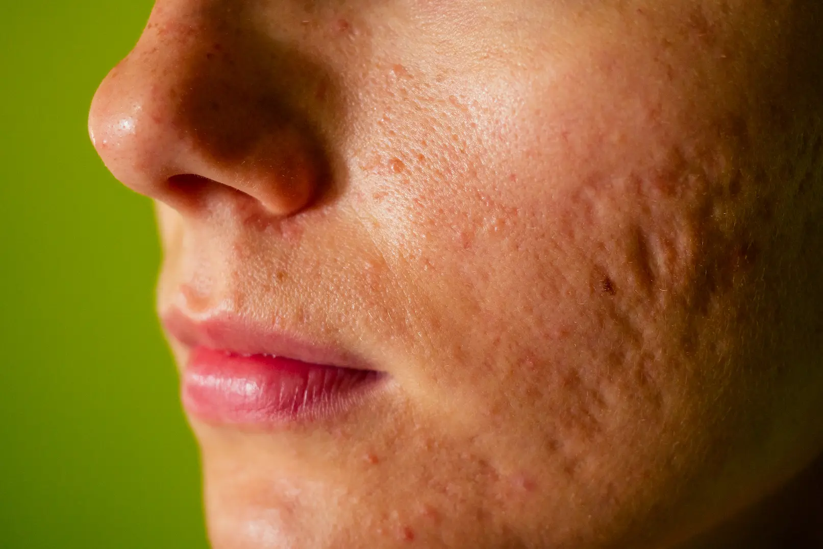 acne scars