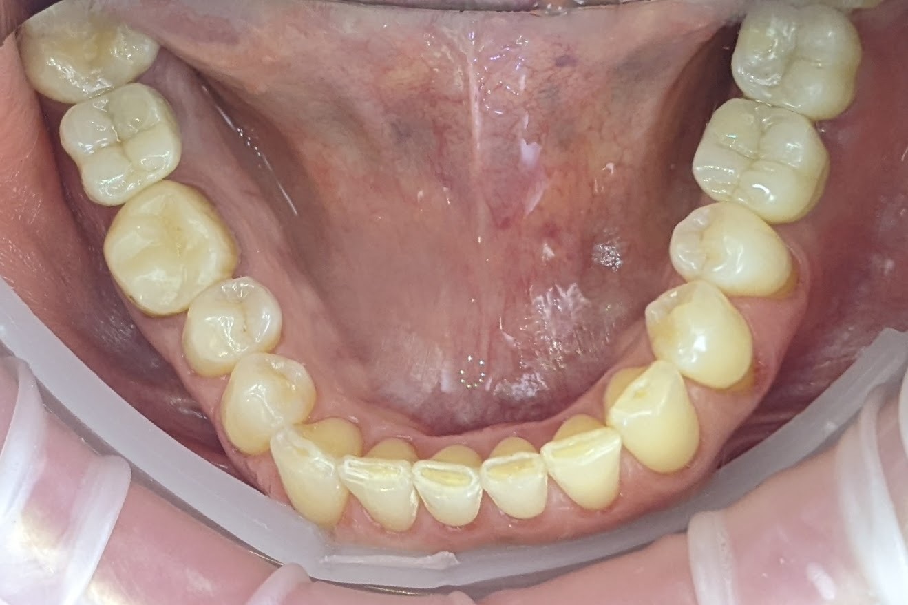 Fogászati Implantátum Tájékoztató