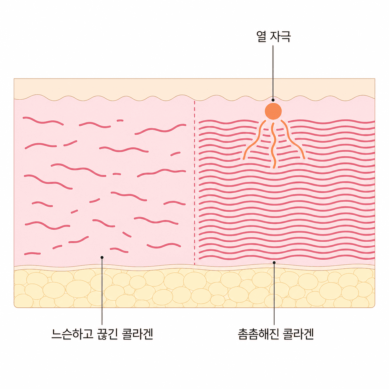 열 자극이 닿은 쪽은 콜라겐이 촘촘해지지만, 그 상태가 그대로 굳어 있지는 않아요.