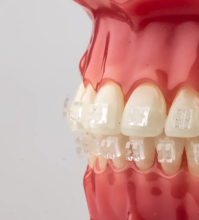 Zdjęcie prezentujące  kosmetyczny aparat na zęby