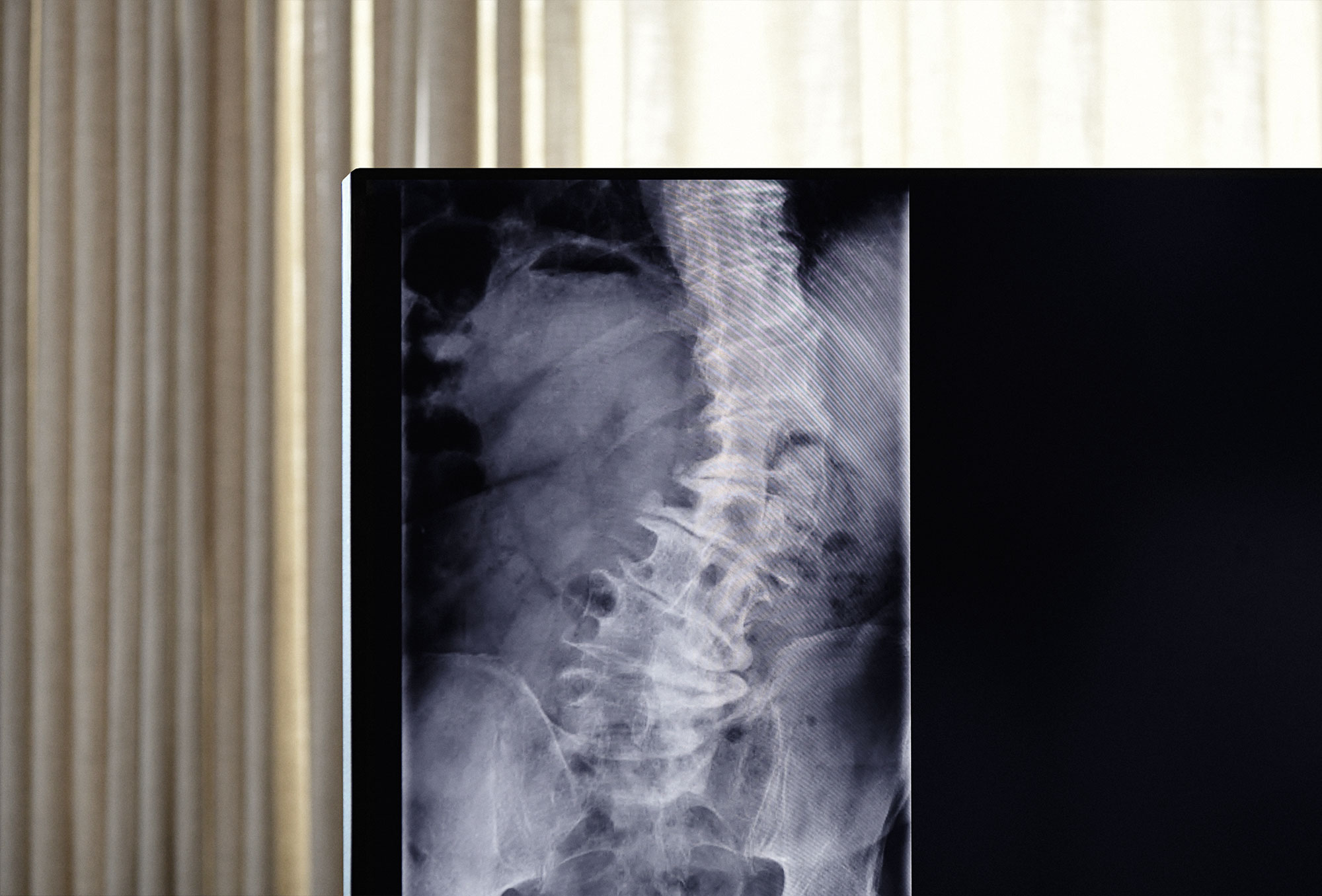 Deformitäten der Wirbelsäule / Skoliose, Kyphose