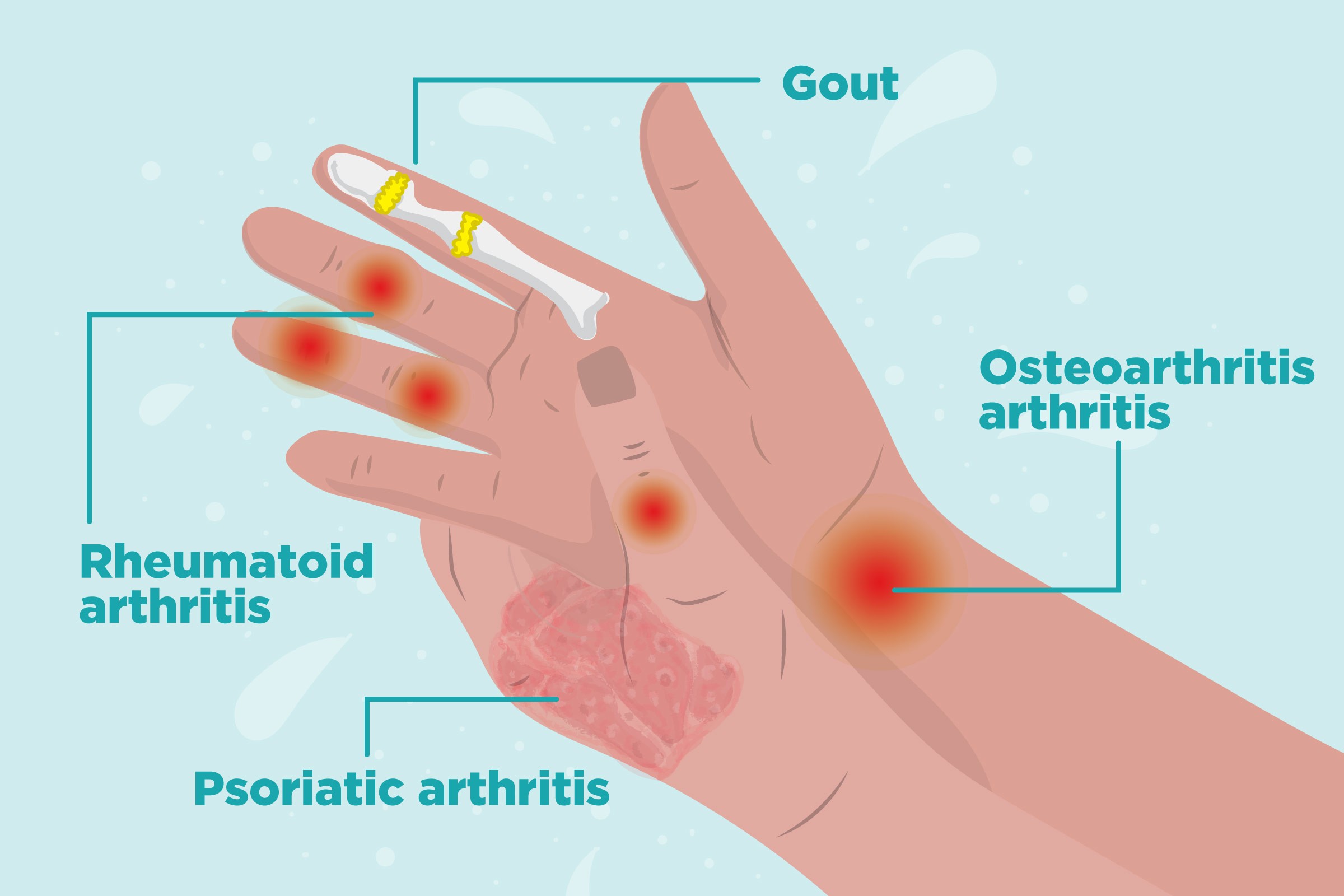 Medical image displaying the hand and its anatomy with different kinds of Arthritis depending ont he location of the pain