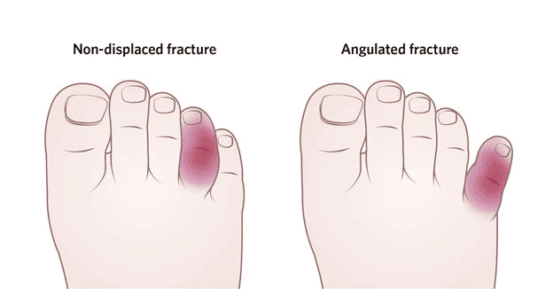 Illustration for Toe and Forefoot Fracture